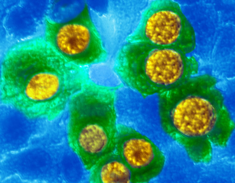 Human cells affected with Chlamydia - 1 - Juarez.png